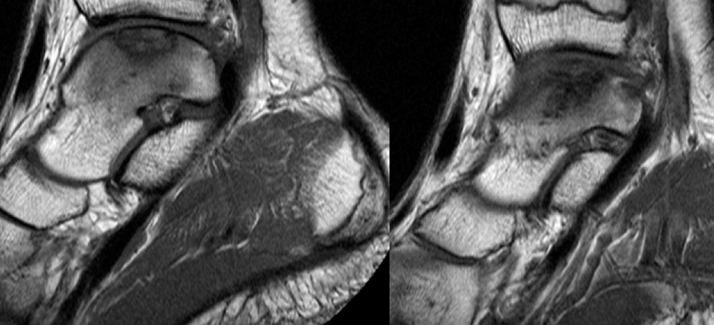 Figure 2 for case Osteochondral lesion talar dome